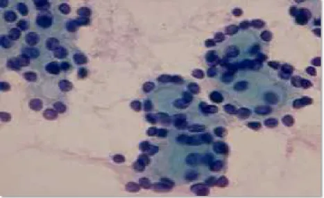 Fig 13: Coarse granular chromatin in follicular neoplasm,Wright Giemsa, 100X