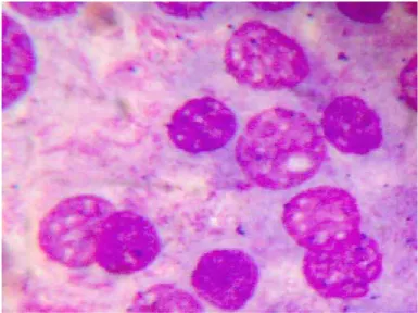 Fig 15: Follicular neoplasm, H&E, 40 X