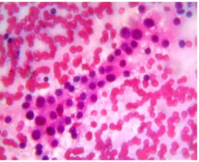 Fig 1: Hashimotos thyroiditis – Wright Giemsa stain, 10 X