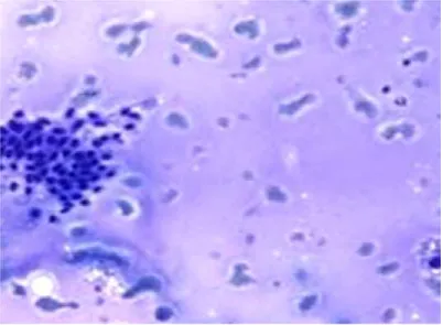 Fig 3: Hurthle cells in Hashimotos thyroiditis – H&E stain, 40 X