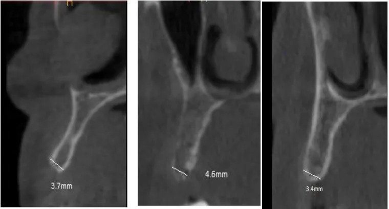 Fig.6  PREOPERATIVE CBCT MEASUREMENT FOR VERTICAL LENGTH OF AVAILABLE BONE  