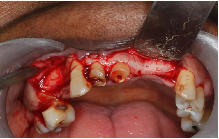 Fig.9  MUCOPERIOSTEAL FLAP REFLECTION 