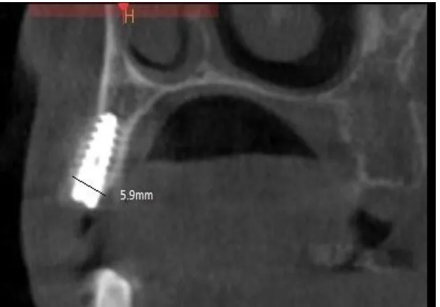 Fig.19  POST OPERATIVE CBCT MEASUREMENT AFTER SIX MONTHS 