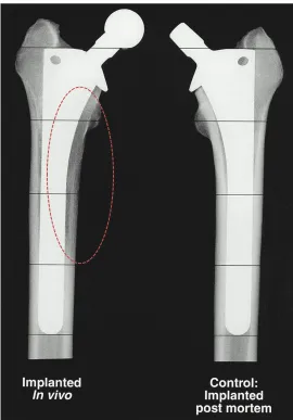 Figure 1-1. Stress shielding. The effects of stress shielding on perimplant bone 