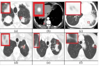Fig 4.2 Examples of classified CISLs: (a) lobulation noised by blood vessel; (b) calcification identified difficultly; (c)  and (d) easy confused AB and CV; (e) and (f) easy confused spiculation and PI