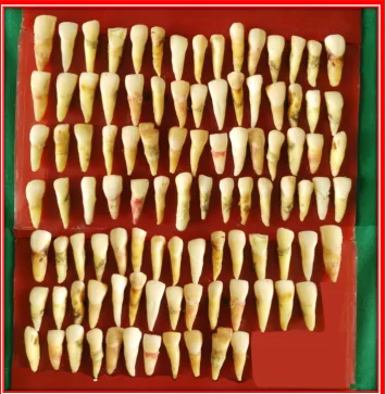 Fig.1: Extracted human maxillary anteriors 