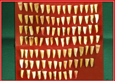 Fig 4: Decoronated maxillary anteriors 