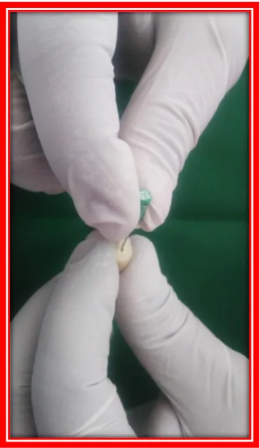 Fig.6: Irrigation done by using 2ml of 3% Naocl and Post-operative radiograph 