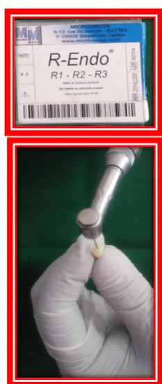Fig.9: Retreatment done with D-race file               Fig.10: Retreatment done  with R-endo file 