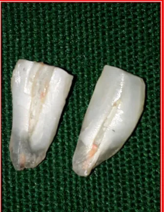 Fig.11: Vertically splitted tooth 