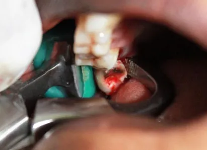 Fig 11.Pre-operative IOPA 