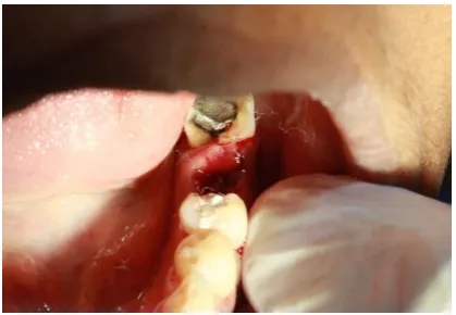 Fig 16.Post-operative extracted socket 