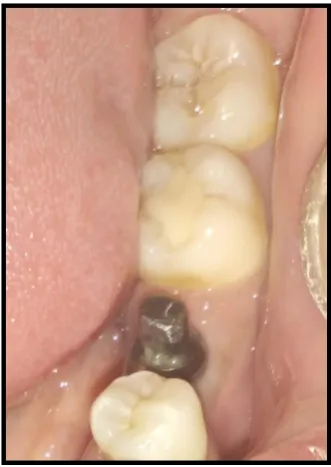 Fig – 31 FOLLOW UP AFTER 3 MONTHS 