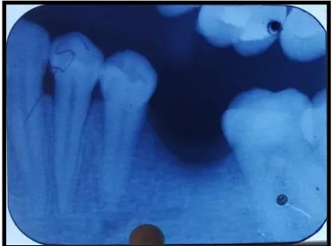 Fig -3 DIAGNOSTIC CASTS 