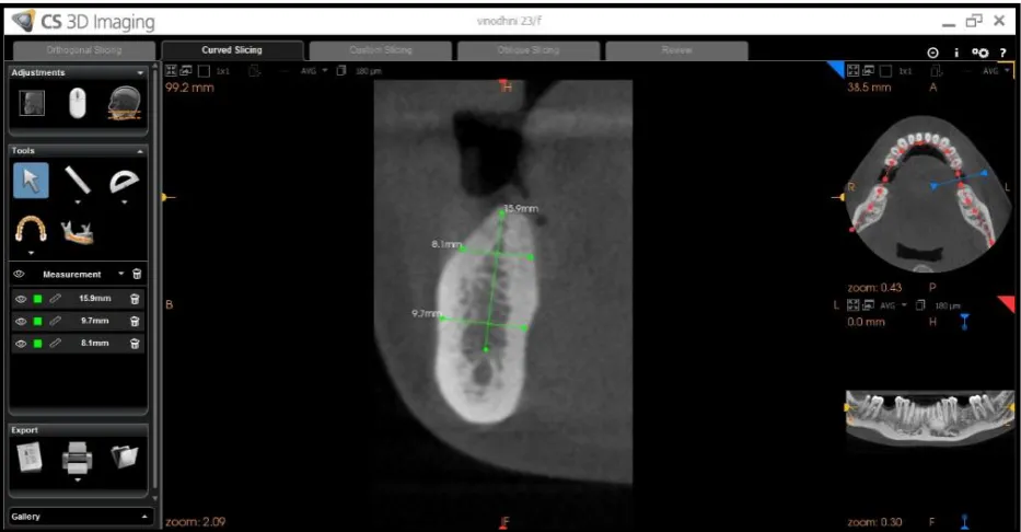 Fig -6 a.CBCT SHOWING 46 REGION 