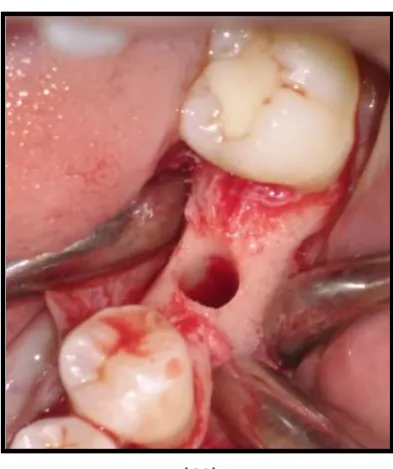 Fig – 14 OSTEOTOMY SITE 