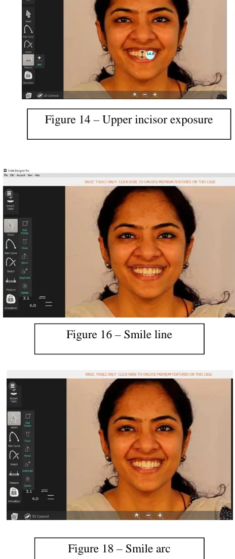 Figure 16 – Smile line 