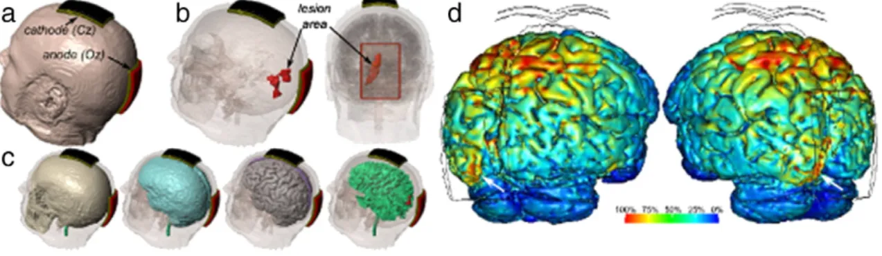 Fig. 1d shows the predicted cortical electric ﬁeld of the patient as a result of tDCS and based on the electrode montage used in this study.