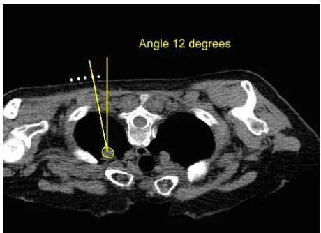Fig. 1.Biopsy path with the desired entry angle.