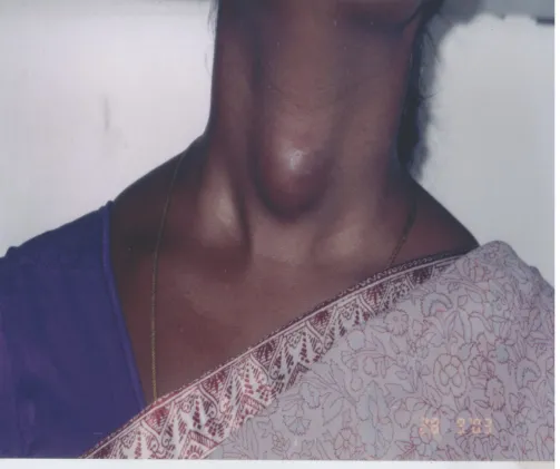 FIG 1: A CASE OF ADENOMA OF THYROID
