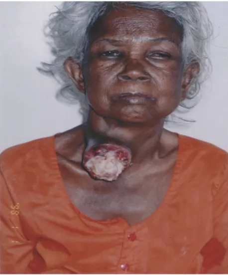 FIG 4: A CASE OF ANAPLASTIC CARCINOMA WITH ULCERATION