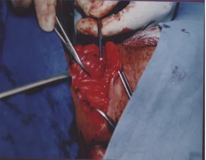 Fig 5: TOTAL THYROIDECTOMY ON PROGRESS. RECURRENTLARYNGEAL NERVE SHOWN  WITH POINTER.