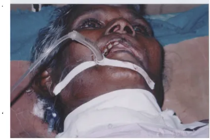 FIG 7(B):  THE  SAME  PATIENTS  ON  ENDOTRACHEALTUBE  WITH  OXYGEN SUPPLEMENTATION POSTOPERATIVELY.
