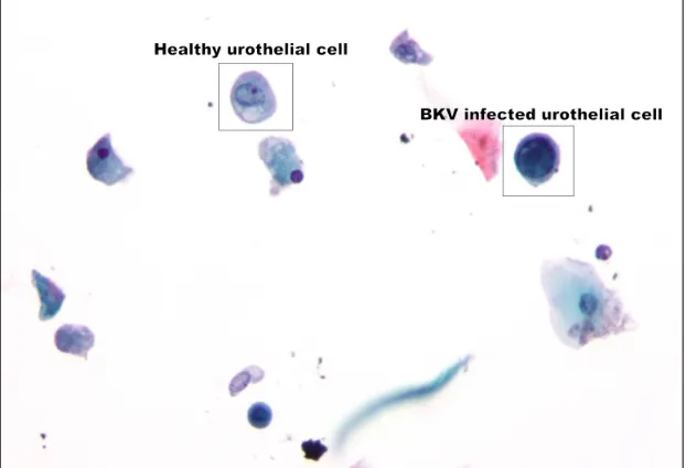 Figure 1.1: Urothelial cell infected by BKV