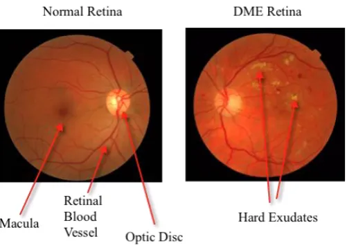 Fig. 1. Normal Retina vs DME Retina Image 