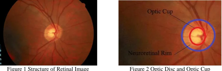 Figure 1 shows major structures of disc. In figure 2 the region inside the blue line is optic disc and region inside red line is optic cup