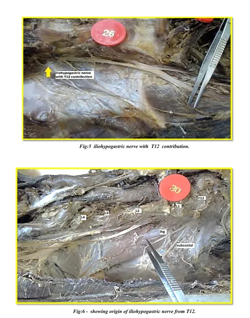 Fig:6 -  showing origin of iliohypogastric nerve from T12. 