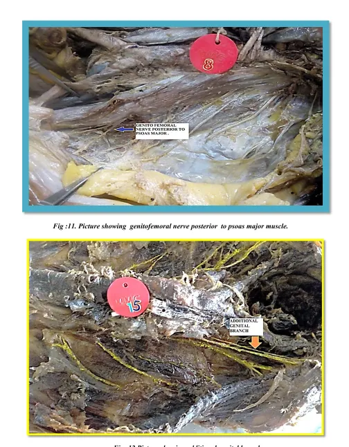 Fig: 12.Picture showing additional genital branch. 