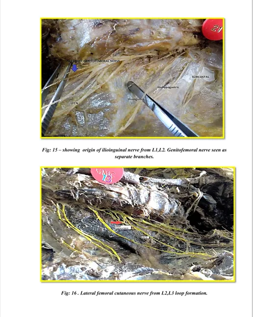 Fig: 15 – showing  origin of ilioinguinal nerve from L1,L2. Genitofemoral nerve seen as 