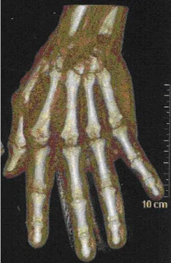 Figure 3. STL meshing of the hand with tria before the reconstruction of the surfaces