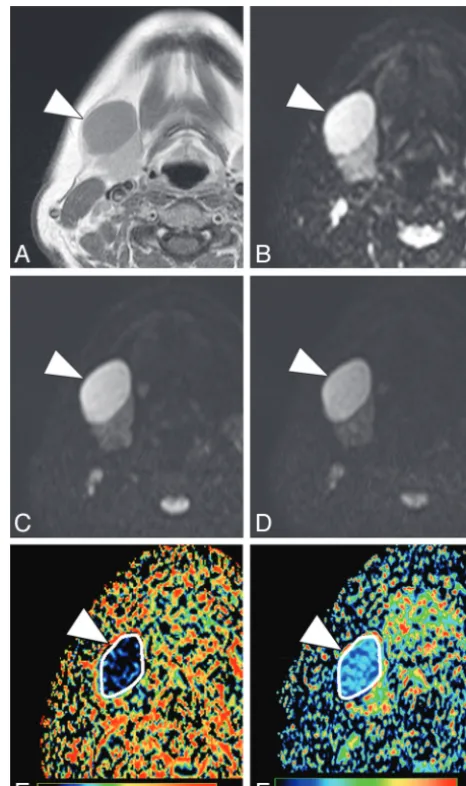 FIG 2. A 50-year-old woman with nodal lymphoma (follicular lym-(phoma). A, Axial contrast-enhanced T1-weighted image shows a ho-mogeneously enhancing tumor (arrowhead) in the submandibularspace