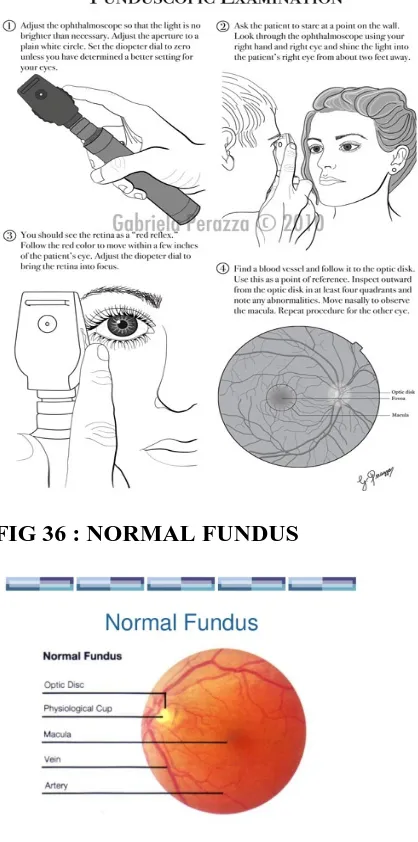 FIG 36 : NORMAL FUNDUS  