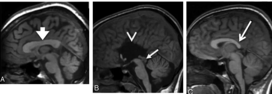 FIG 4. Examples of 3 different corpus callosum abnormalities.Note tectal glioma ( A, Thick corpus callosum (arrow)