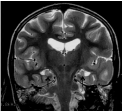 FIG 7. Images of twin sibling pair 1 (Fig 1shown) were small cerebella, small posterior fossa cysts, and thinned posterior white matterincluding the posterior corpus callosum