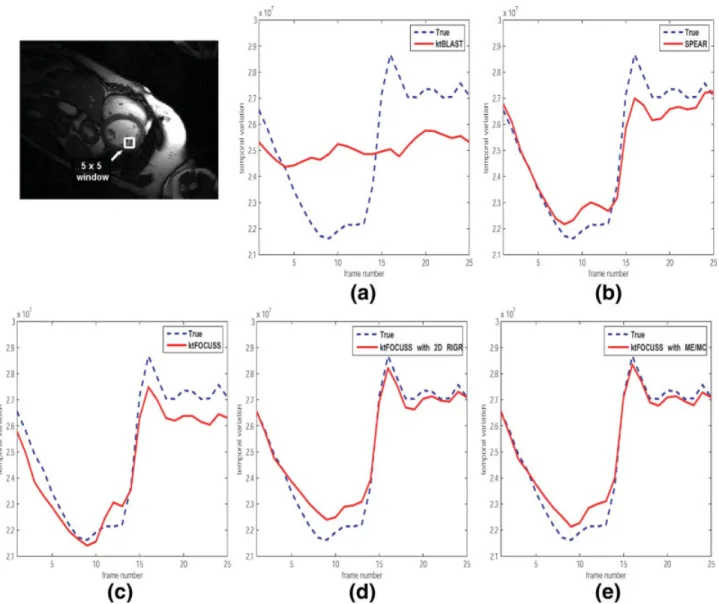 FIG. 7. The temporal variation of averaged signals in 5 × 5 pixels ROI for the case of (a) k-t BLAST, (b) SPEAR, (c) k-t FOCUSS with temporal average, (d) k-t FOCUSS with 2-D RIGR, and (e) k-t FOCUSS with ME/MC, respectively