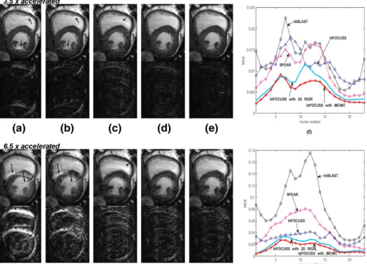 FIG. 5. Comparison of various reconstruction methods, (a) k-t BLAST, (b) SPEAR, (c) k-t FOCUSS with temporal average, (d) k-t FOCUSS with 2-D RIGR, and (e) k-t FOCUSS with ME/MC