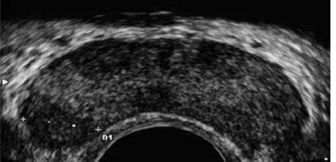 Figure 5. TRUS image in prostatic carcinoma 