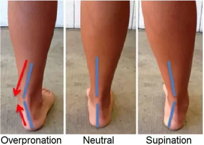 Figure 1. Pronation (Bumgardner, 2018). 