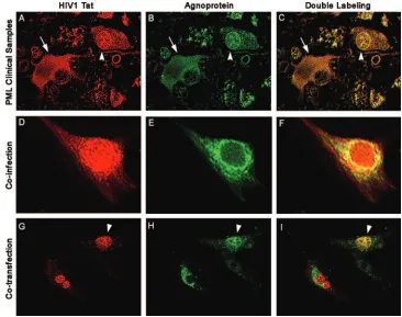 FIG. 1. Colocalization of HIV-1 Tat and JCV agnoprotein in astrocytes. (A to C) Immunoﬂuorescence for the HIV-1 transactivator proteinTat demonstrates robust expression in the cytoplasm and weaker expression in the nuclear compartment of bizarre astrocytes within demyelinated