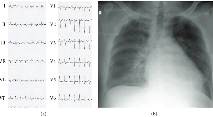 Figure 1: Twelve-lead electrocardiogram (ECG) (a) and chest X-ray on admission (b). ECG shows narrow QRS tachycardia suggestingparoxysmal supraventricular tachycardia