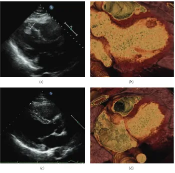 Figure 2: Imaging findings of a ball mass in the left ventricle (LV) on admission. This imaging revealed a ball mass (arrow) in the left ventricle(LV) detected by transthoracic echocardiography (TTE) (a) and contrast enhanced computed tomography (CT) (b)
