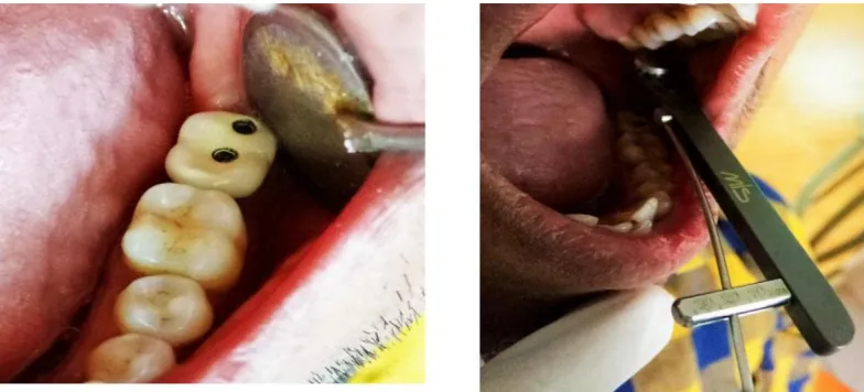 Fig; OCCLUSION