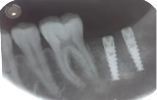 FIG. 13: PREOPERATIVE IOPA 