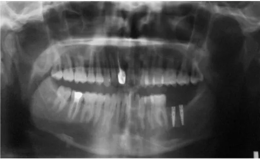 FIG. 16: PREOPERATIVE OPG 