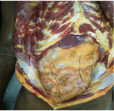 Fig 4: Exposing the abdominal aorta after midline incision. 
