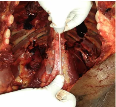 Fig 6: Length of the abdominal aorta from the aortic hiatus until the 